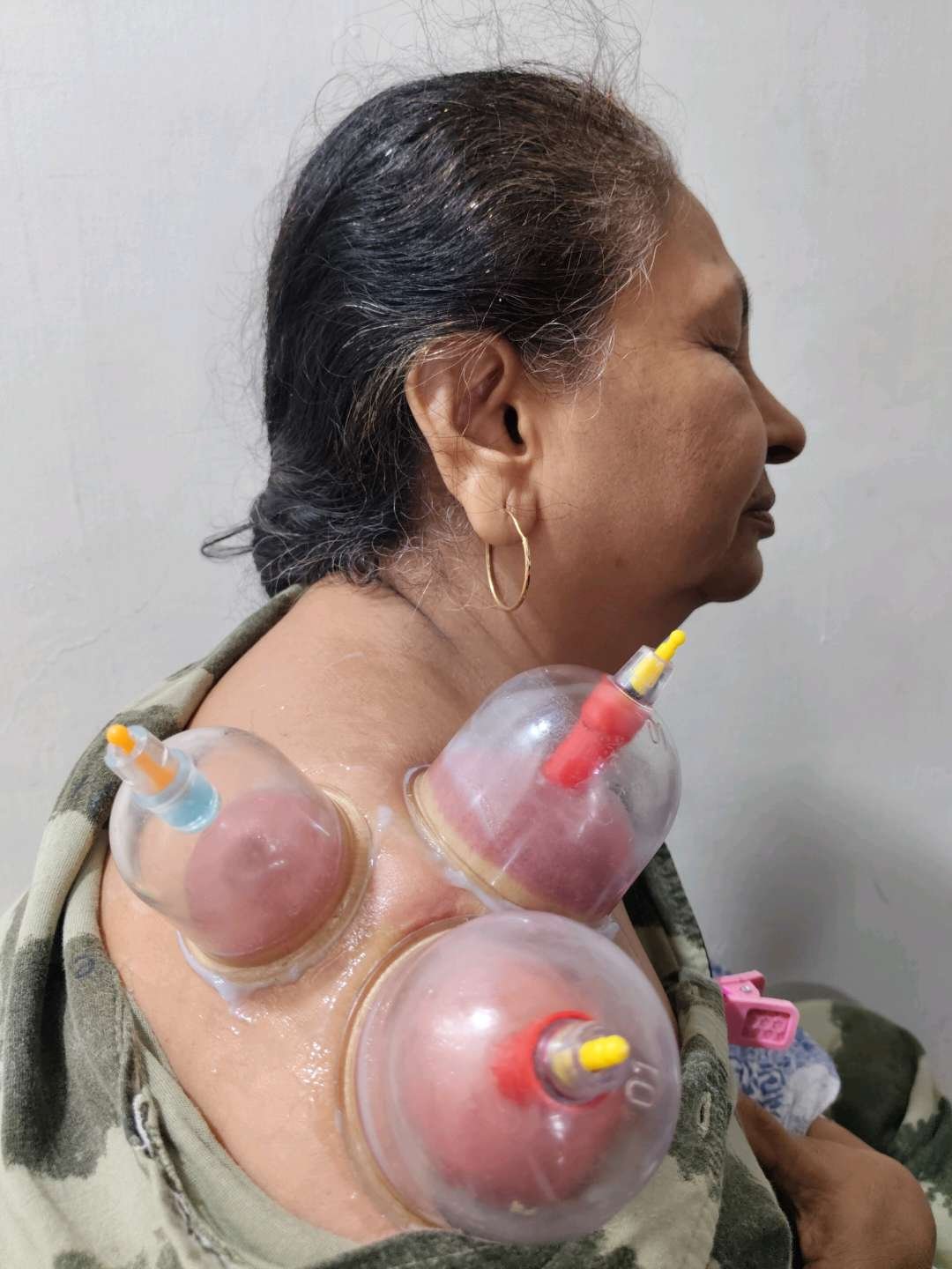 Cupping Therapy (Hijama)